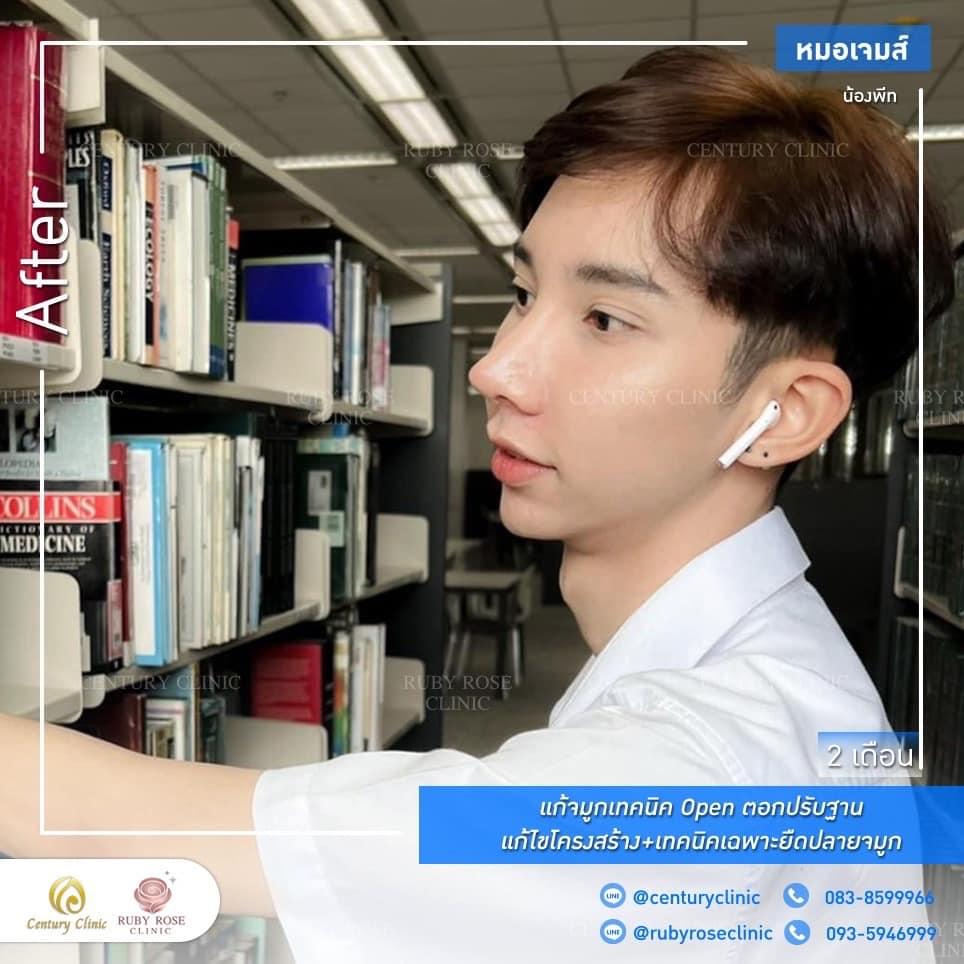 Century รีวิว แก้จมูก #192