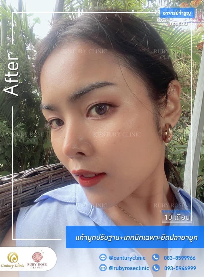 Century รีวิว แก้จมูก #196