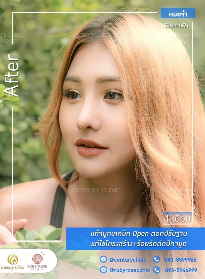 Century รีวิว แก้จมูก #198