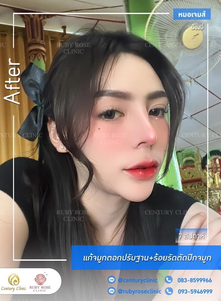 Century รีวิว แก้จมูก #199