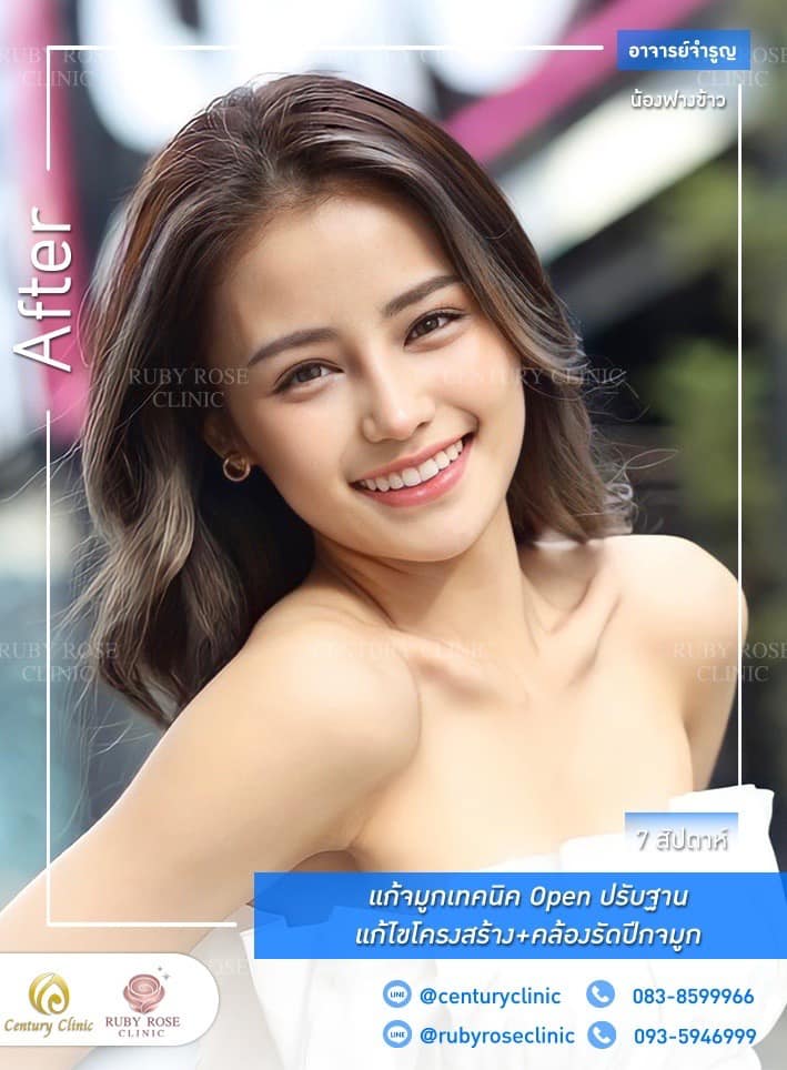 Century รีวิว แก้จมูก #200