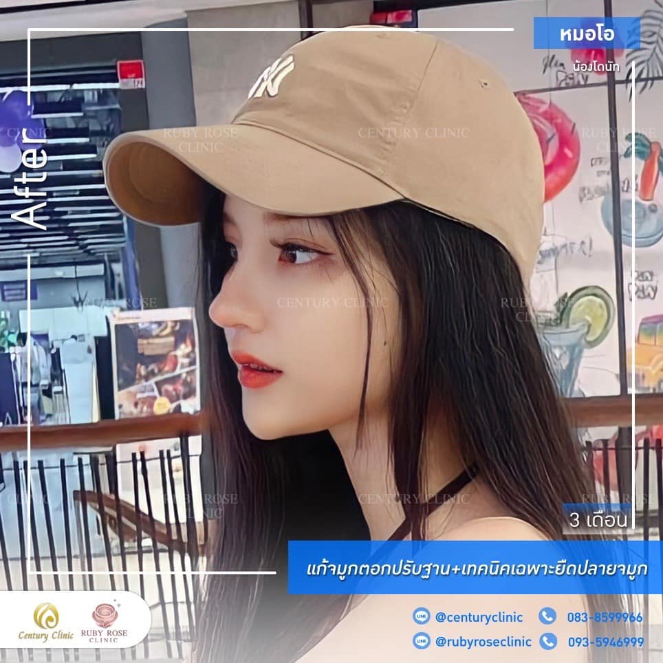 Century รีวิว แก้จมูก #202