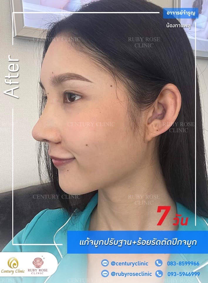 Century รีวิว แก้จมูก #204