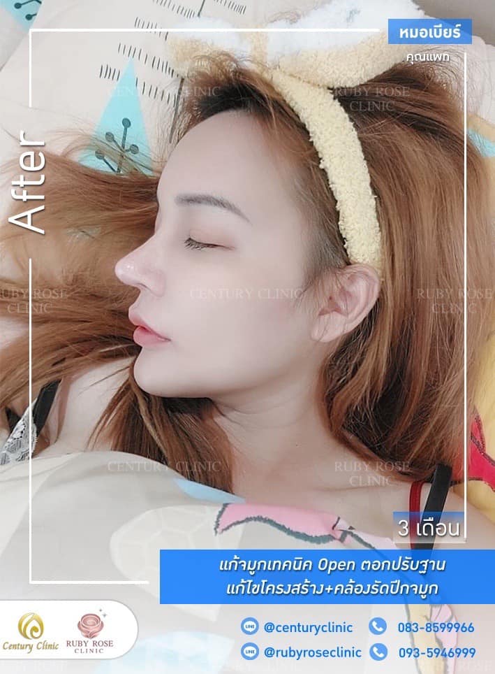 Century รีวิว แก้จมูก #205