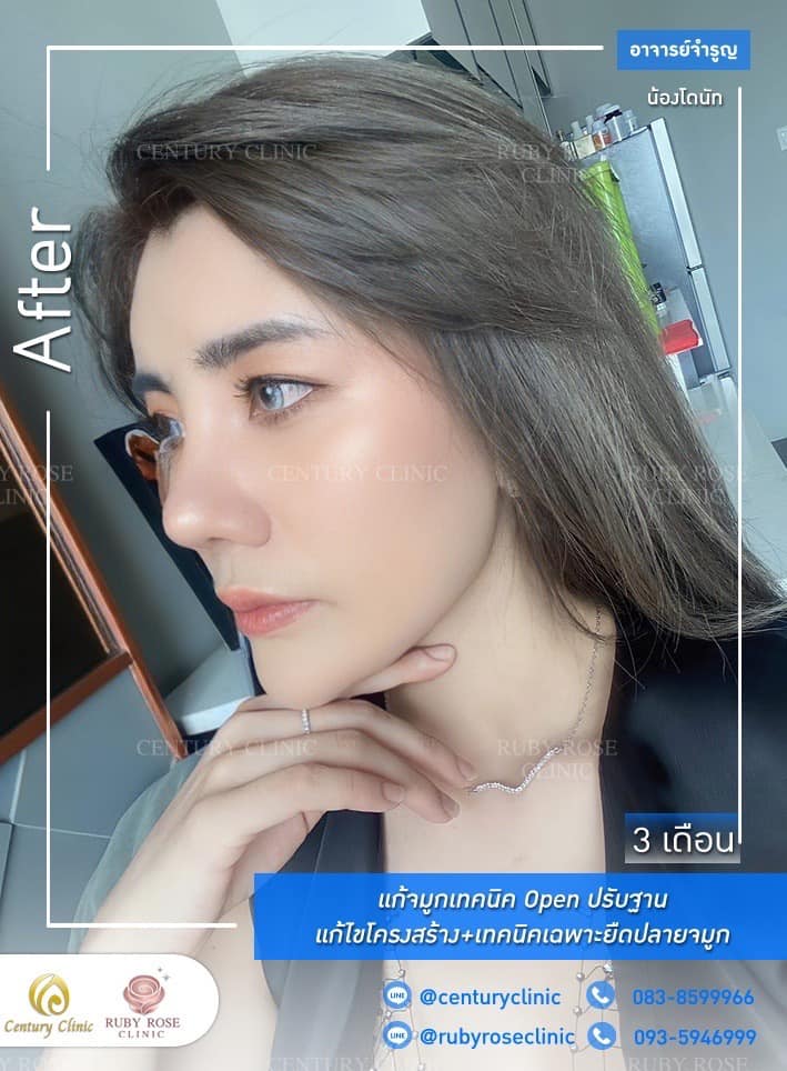 Century รีวิว แก้จมูก #206
