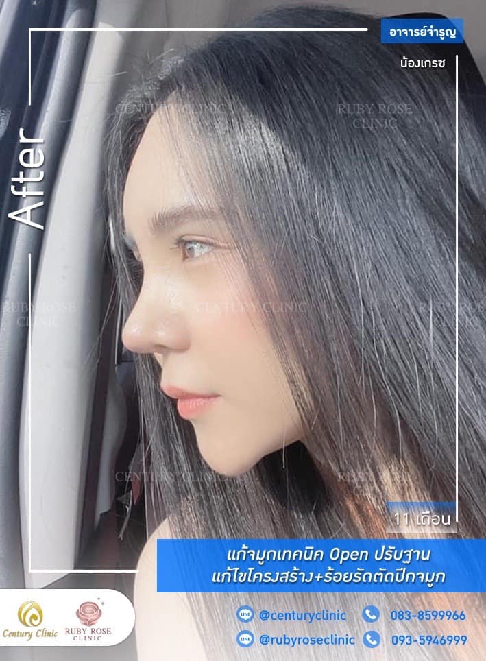 Century รีวิว แก้จมูก #207
