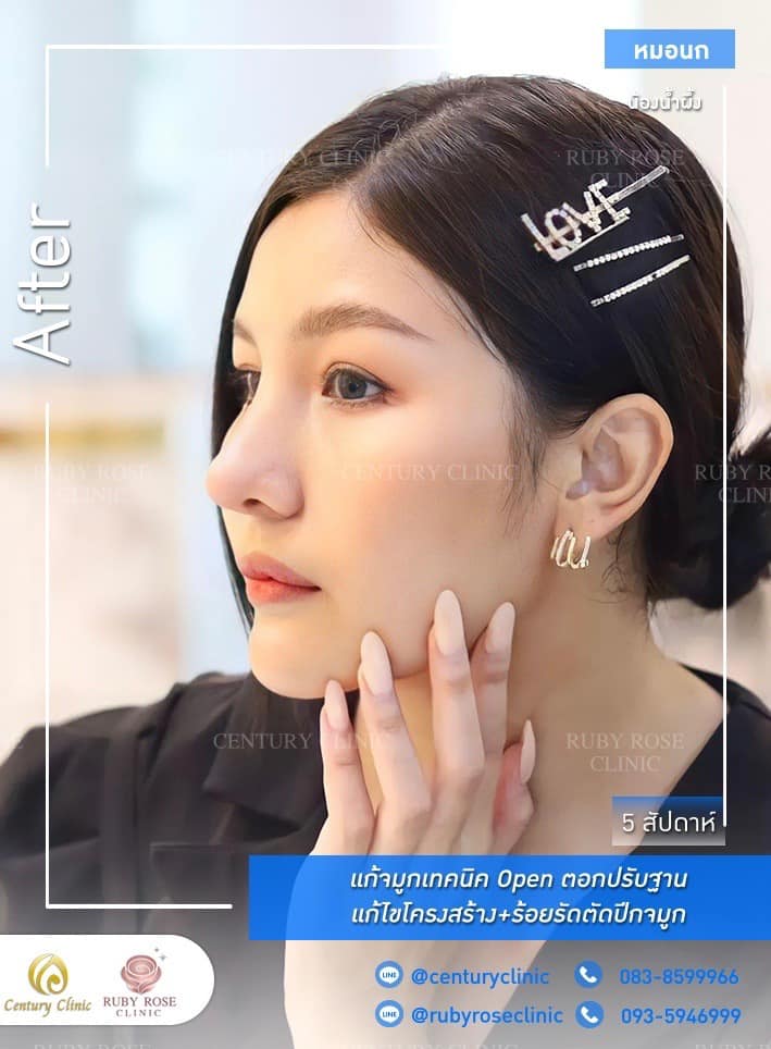 Century รีวิว แก้จมูก #209