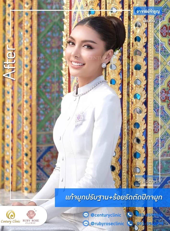 Century รีวิว แก้จมูก #211