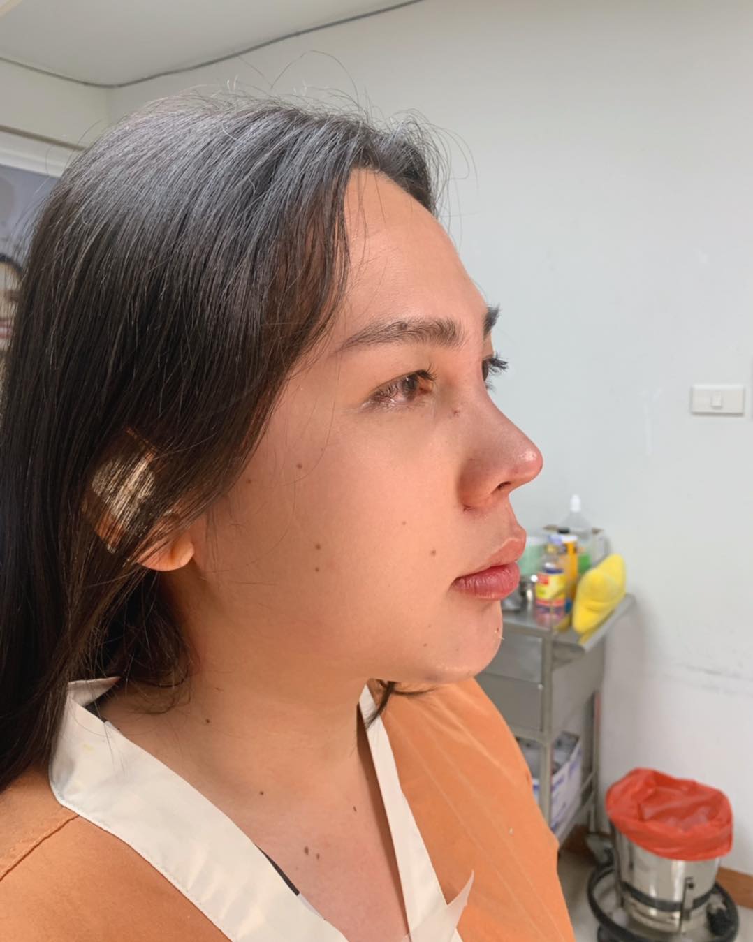 รีวิว แก้จมูก #213 , Century Clinic Thailand Century รีวิว แก้จมูก #213