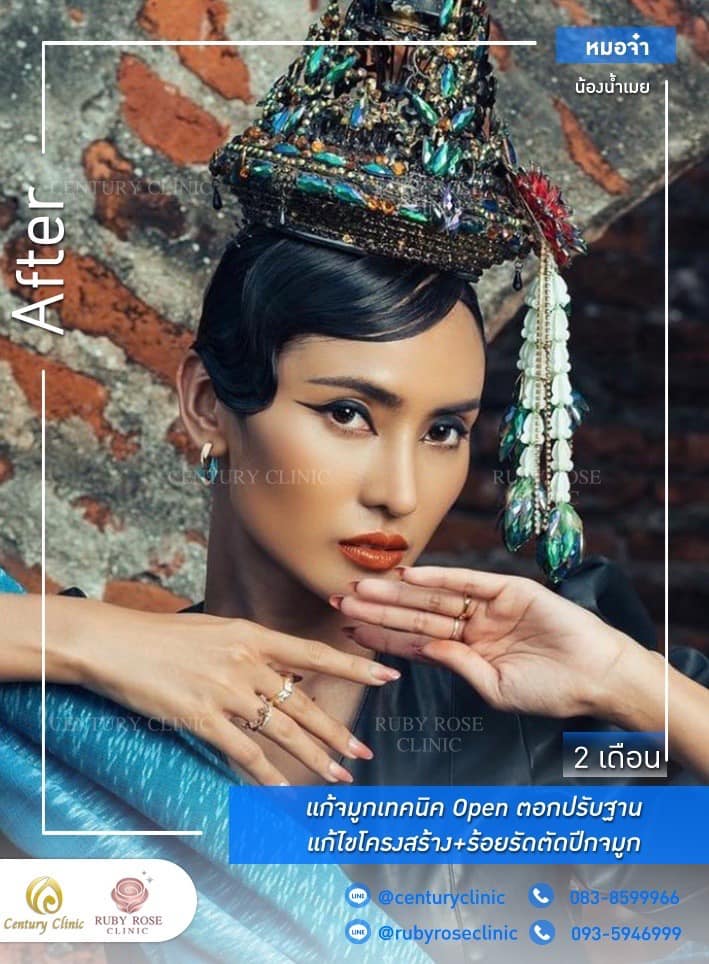 Century รีวิว แก้จมูก #215