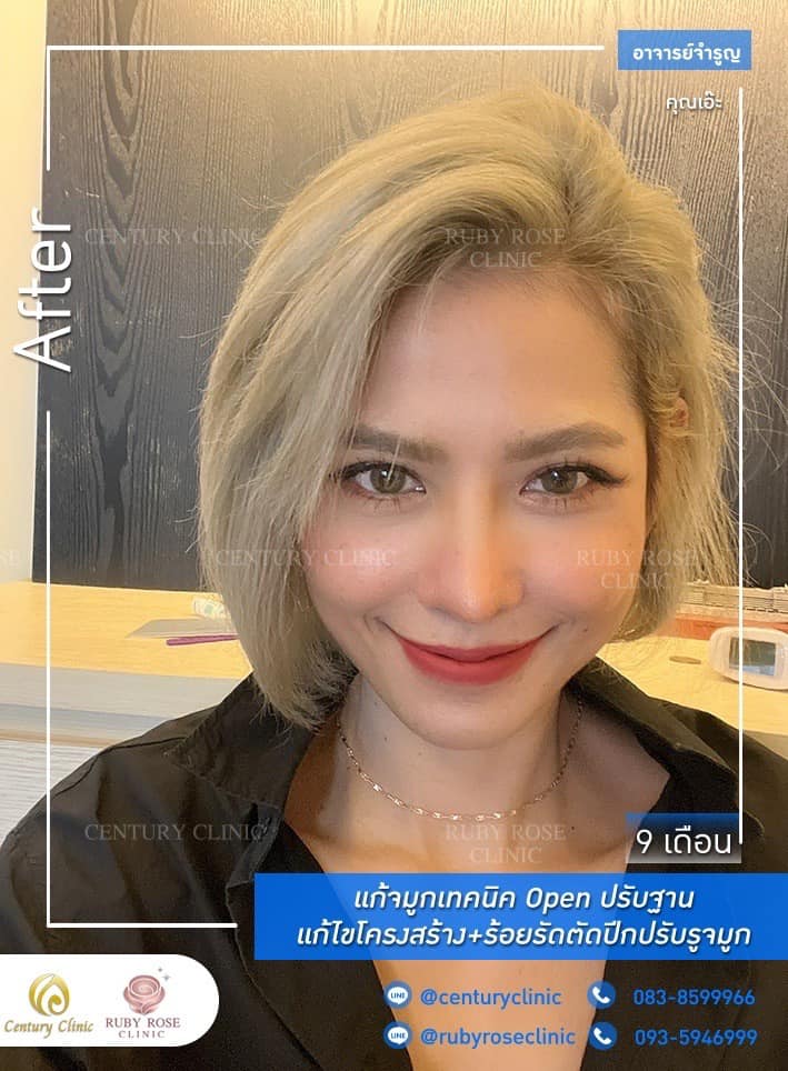 Century รีวิว แก้จมูก #216