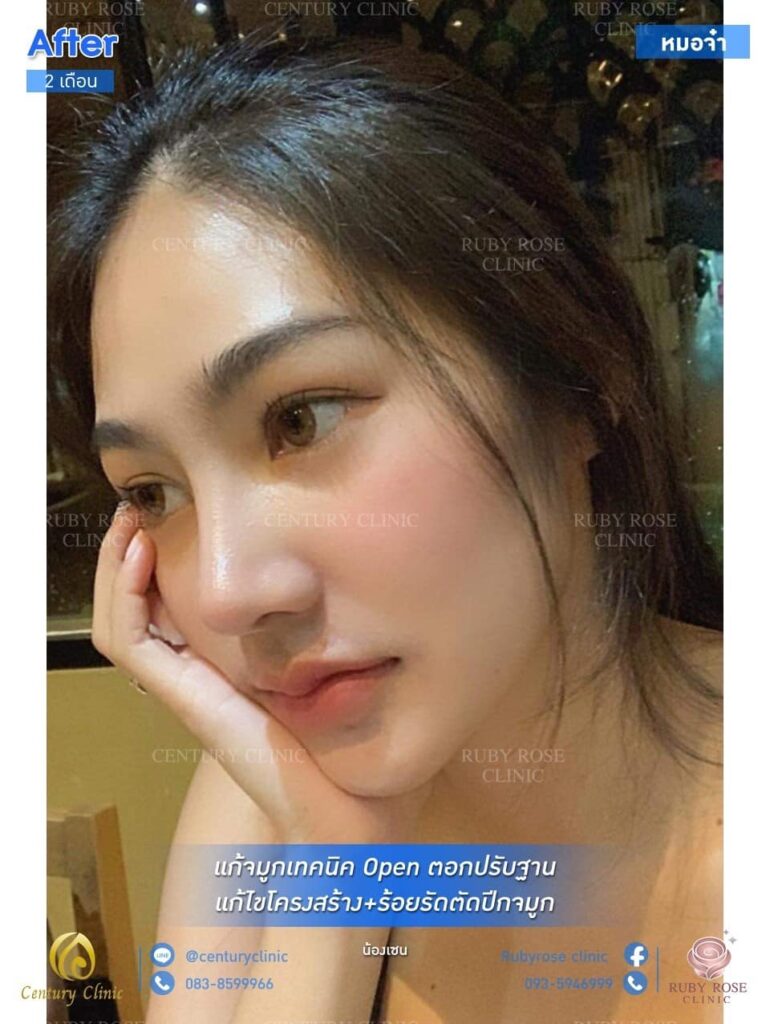 Century รีวิว แก้จมูก 2#161