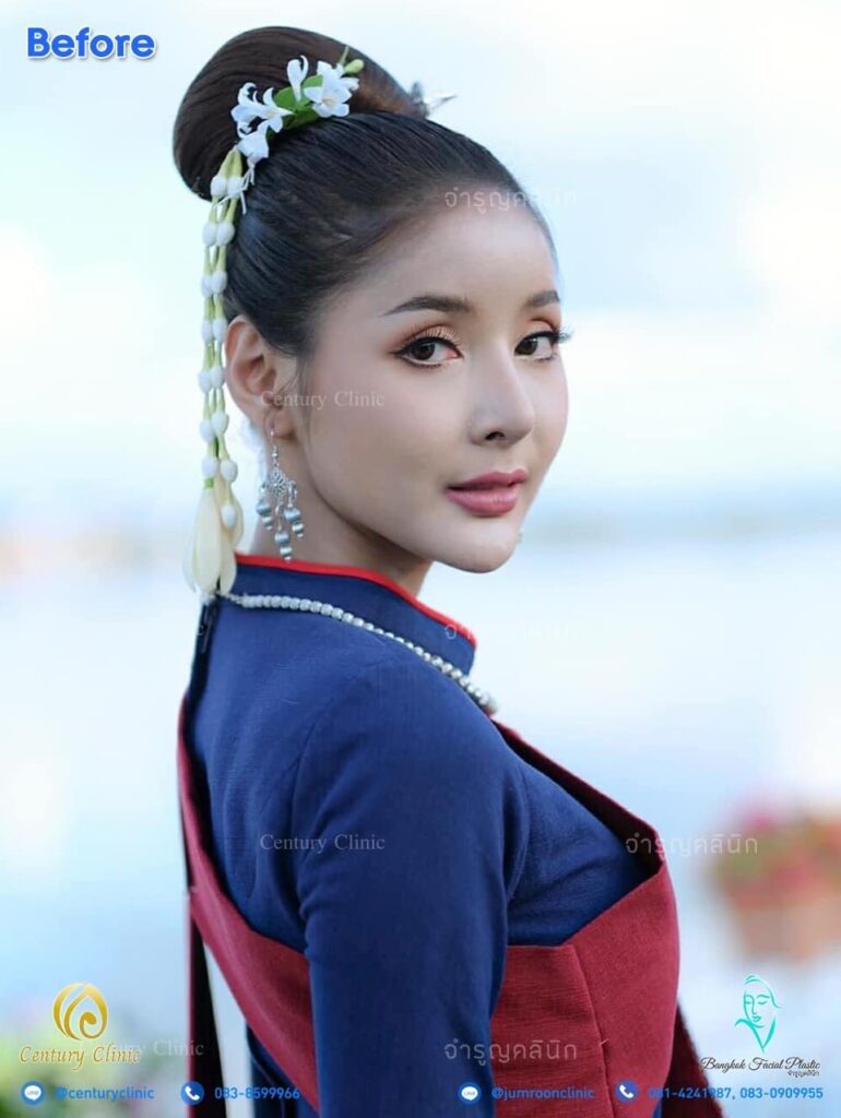 Century รีวิว แก้จมูก 2#168