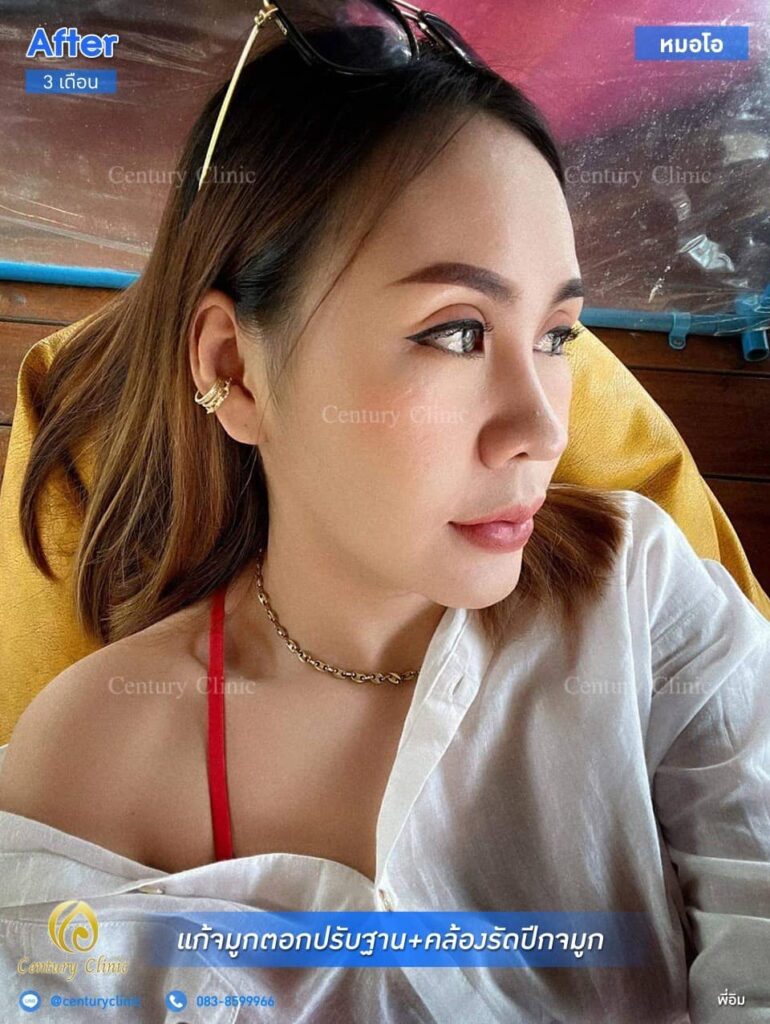 Century รีวิว แก้จมูก 2#171