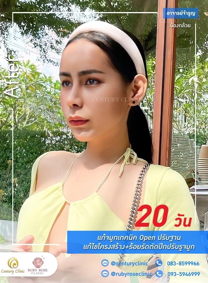 Century รีวิว แก้จมูก #218