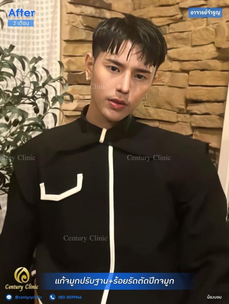 รีวิว แก้จมูก #181 , Century Clinic Thailand Century รีวิว แก้จมูก 2#181