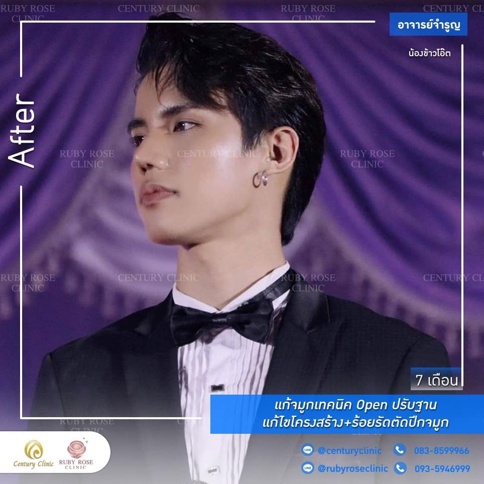 Century รีวิว แก้จมูก 2#190