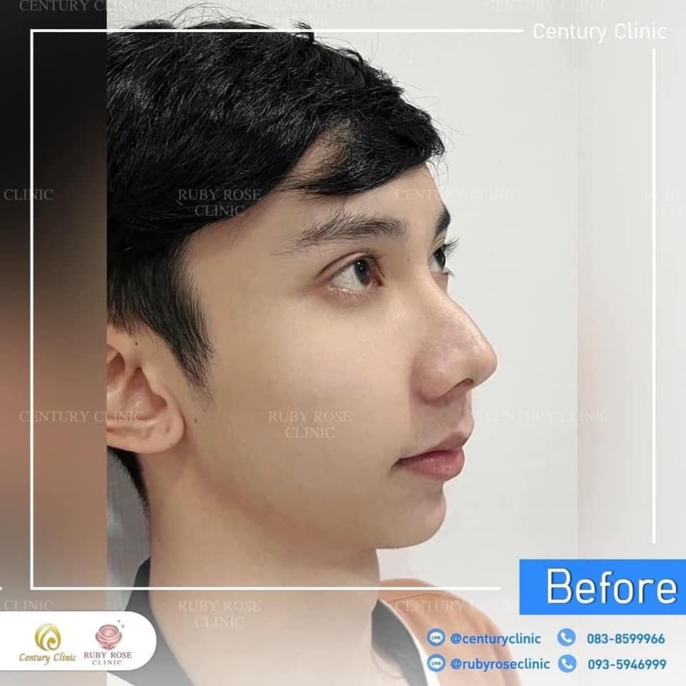 Century รีวิว แก้จมูก 2#192