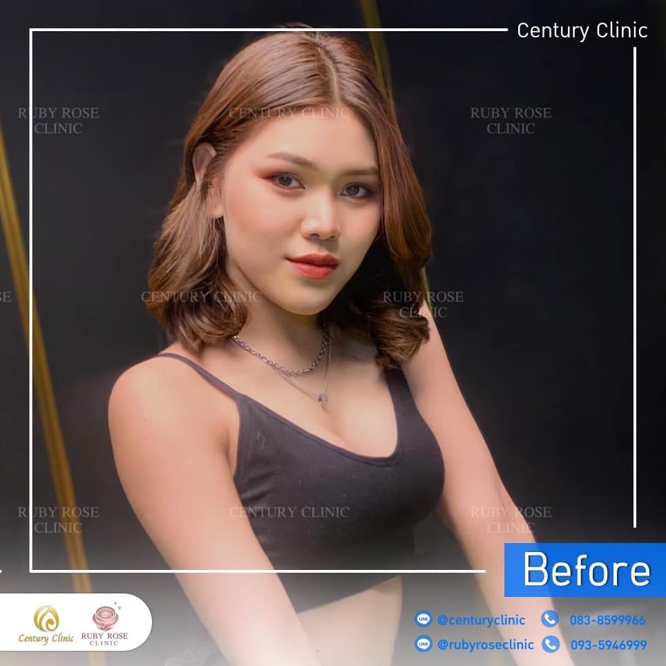 Century รีวิว แก้จมูก 2#195