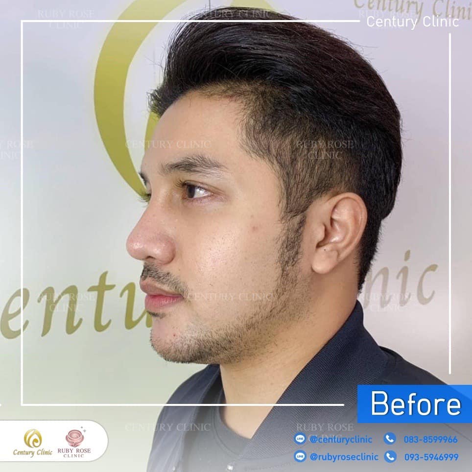 Century รีวิว แก้จมูก 2#201