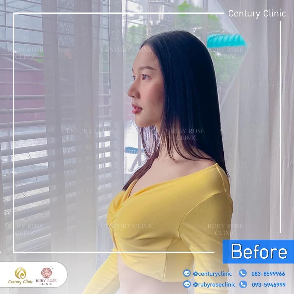 Century รีวิว แก้จมูก 2#204