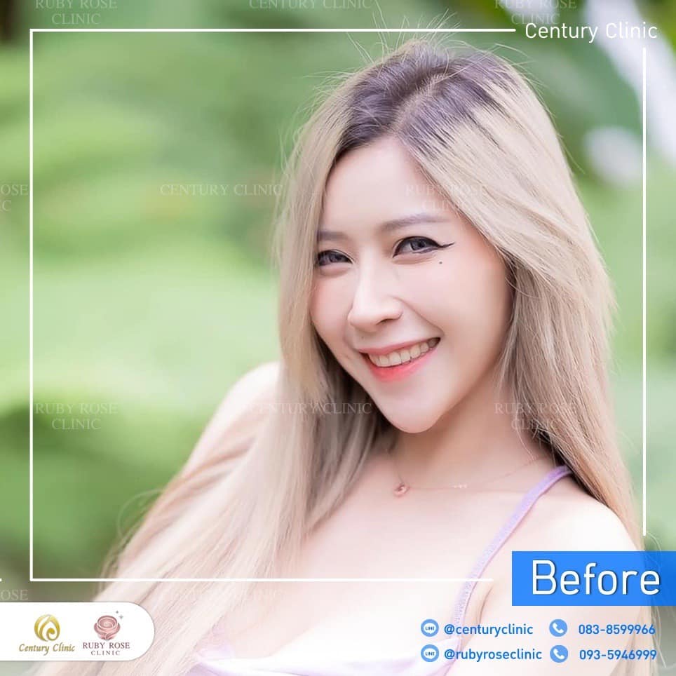 Century รีวิว แก้จมูก 2#208