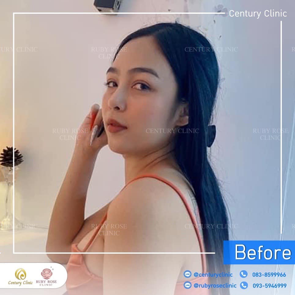 รีวิว แก้จมูก #212 , Century Clinic Thailand Century รีวิว แก้จมูก 2#212