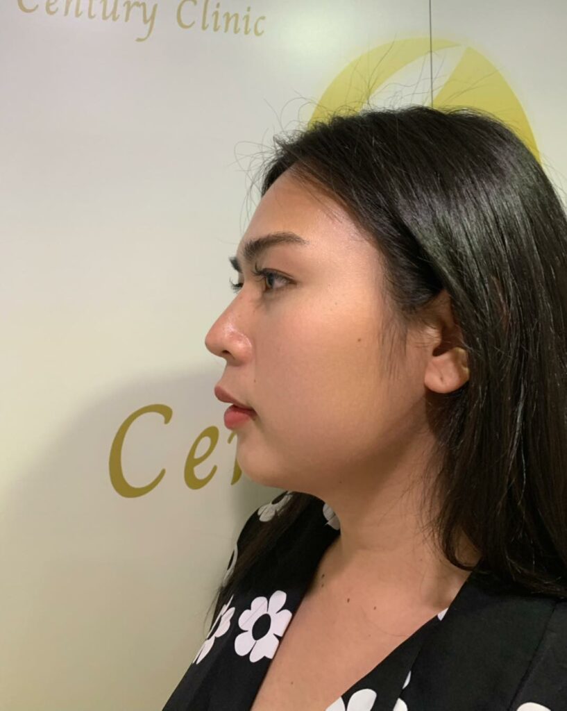 รีวิว แก้จมูก #213 , Century Clinic Thailand Century รีวิว แก้จมูก 2#213