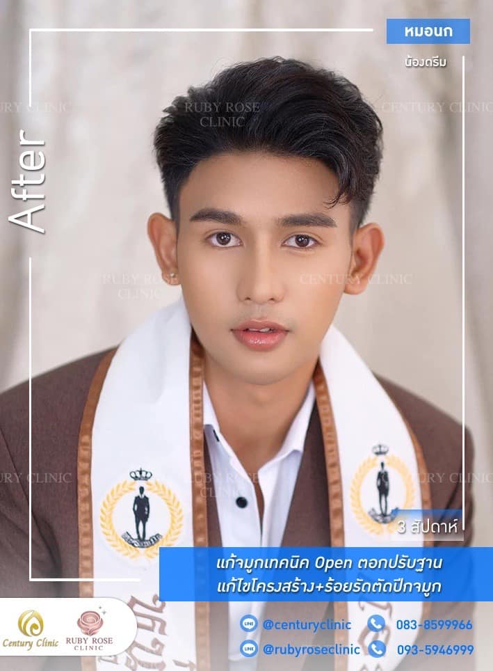 Century รีวิว แก้จมูก #222