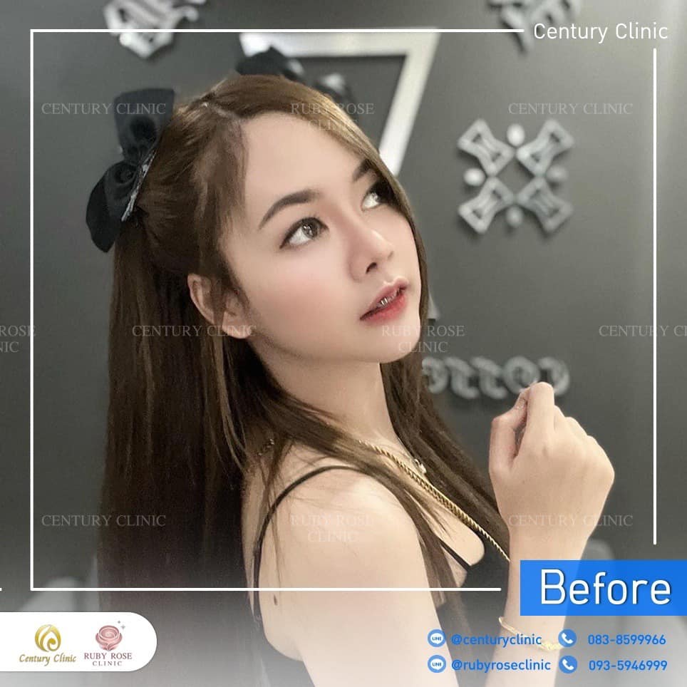 Century รีวิว แก้จมูก 2#221