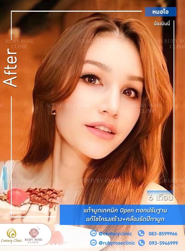 รีวิว แก้จมูก #223 , Century Clinic Thailand Century รีวิว แก้จมูก 2#223