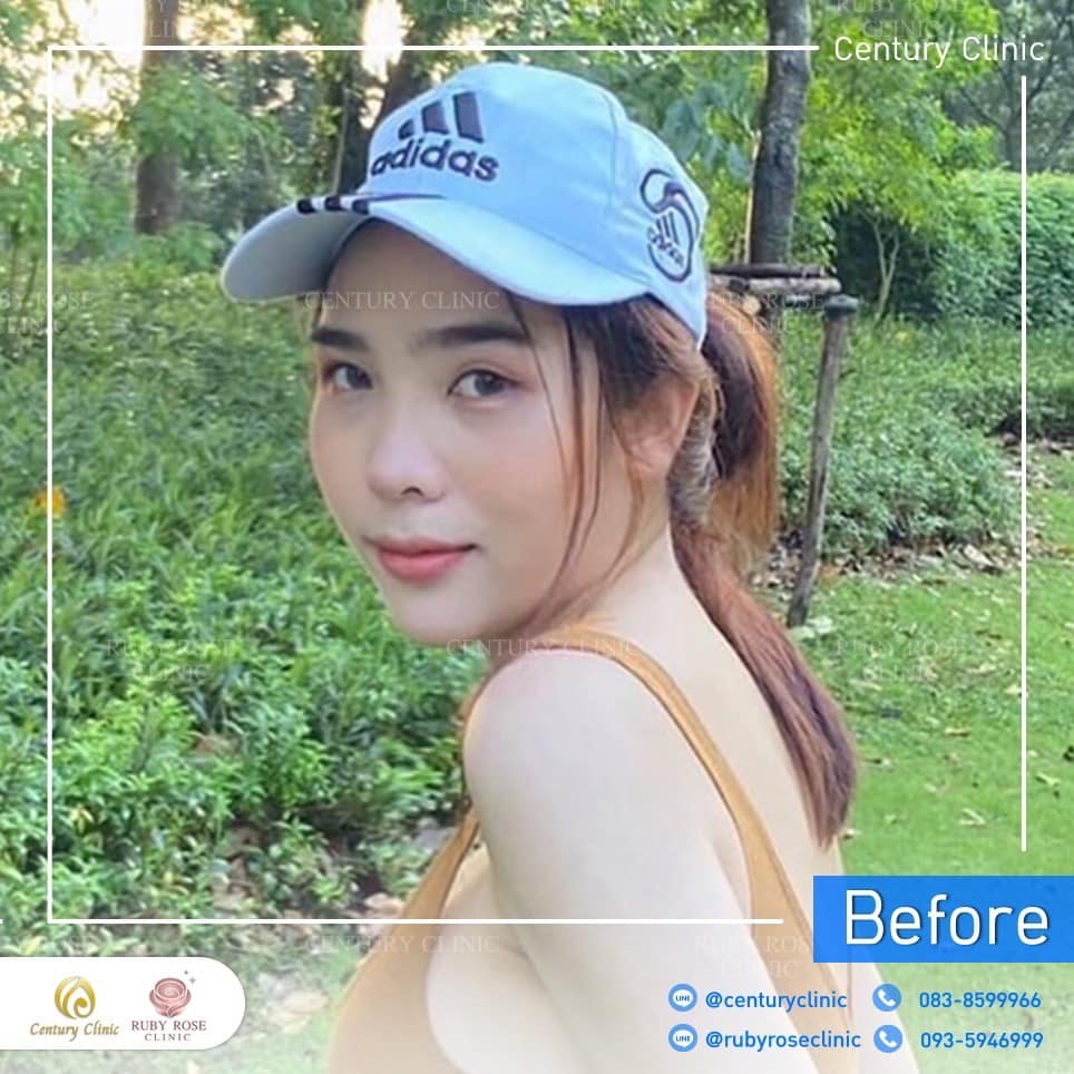 Century รีวิว แก้จมูก 2#224