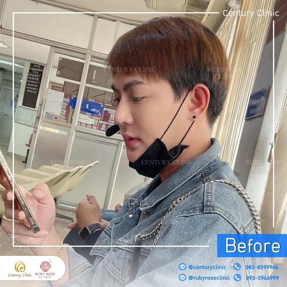 รีวิว แก้จมูก #235 , Century Clinic Thailand Century รีวิว แก้จมูก 2#235