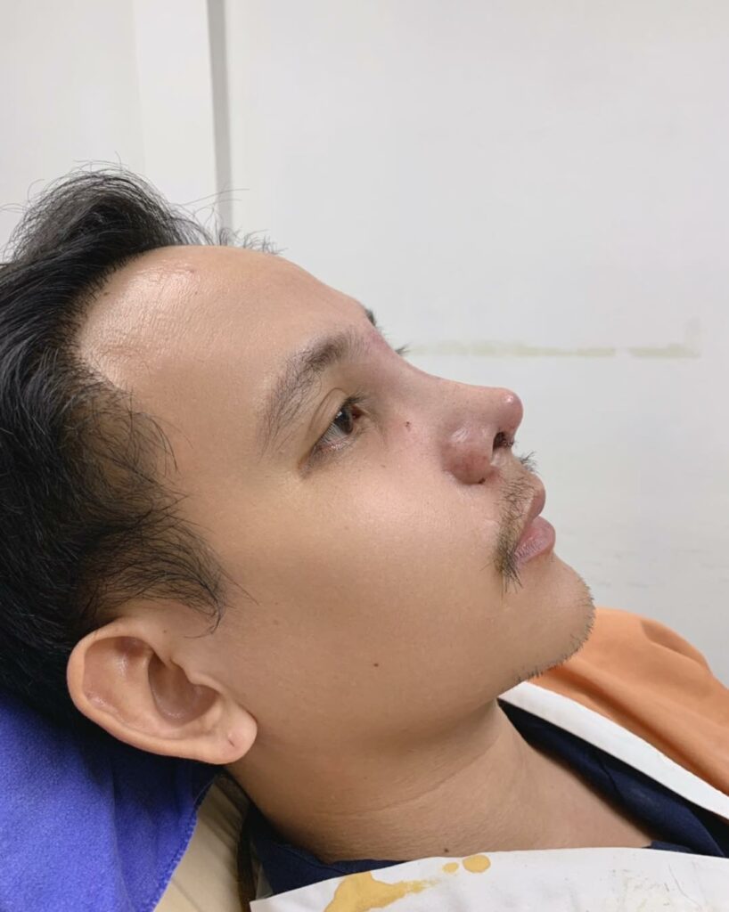 รีวิว แก้จมูก #237 , Century Clinic Thailand Century รีวิว แก้จมูก 2#237