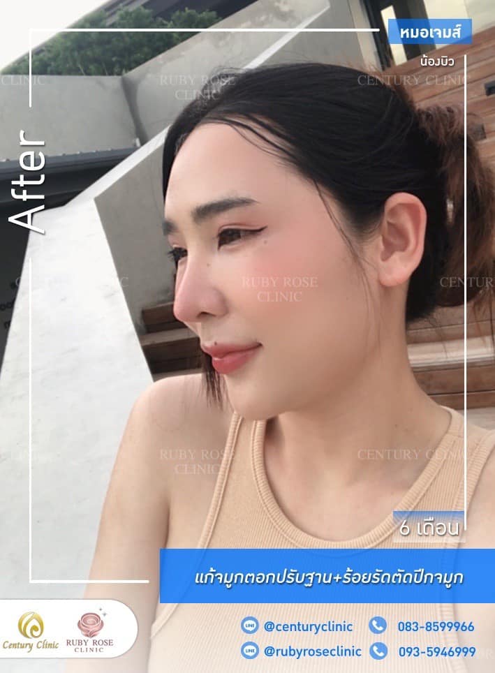Century รีวิว แก้จมูก #224