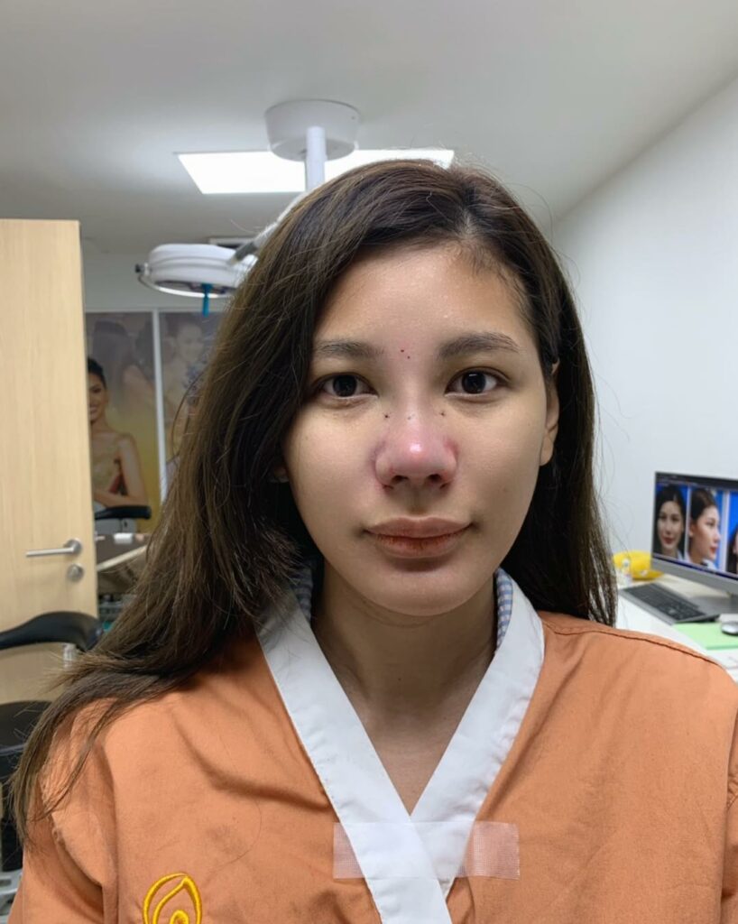 รีวิว แก้จมูก #242 , Century Clinic Thailand Century รีวิว แก้จมูก 2#241