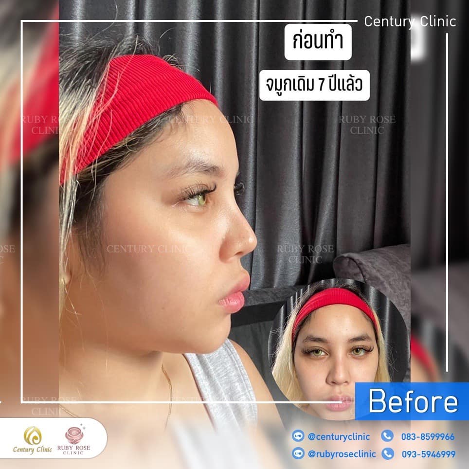 รีวิว แก้จมูก #243 , Century Clinic Thailand Century รีวิว แก้จมูก 2#242