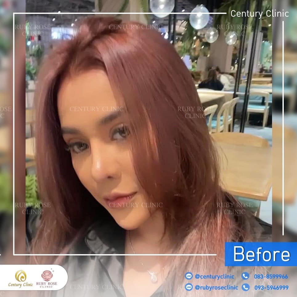 รีวิว แก้จมูก #249 , Century Clinic Thailand Century รีวิว แก้จมูก 2#249