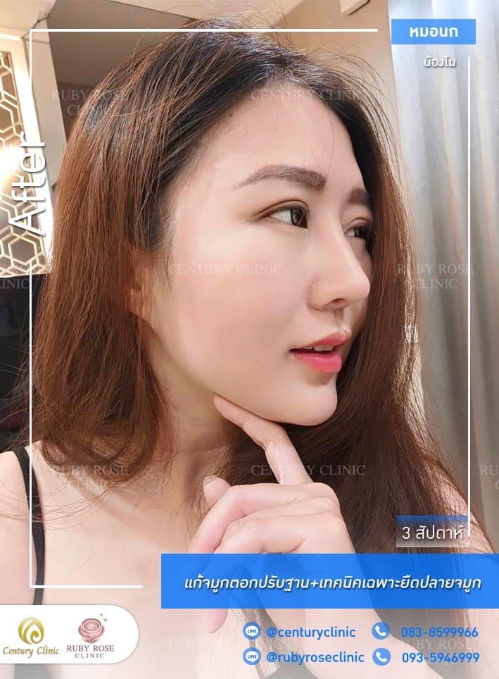 Century รีวิว แก้จมูก #225