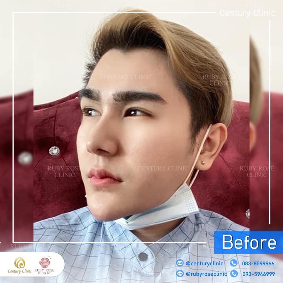รีวิว แก้จมูก #251 , Century Clinic Thailand Century รีวิว แก้จมูก 2#251