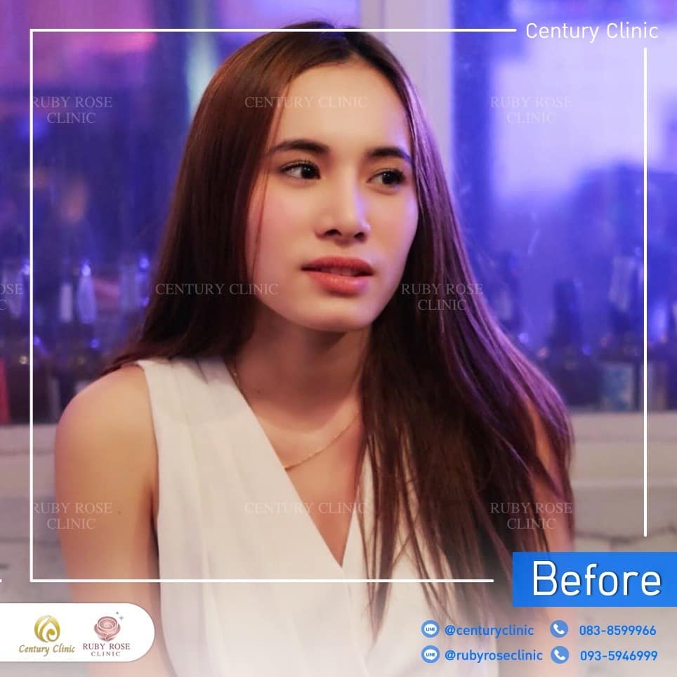 รีวิว แก้จมูก #252 , Century Clinic Thailand Century รีวิว แก้จมูก 2#252