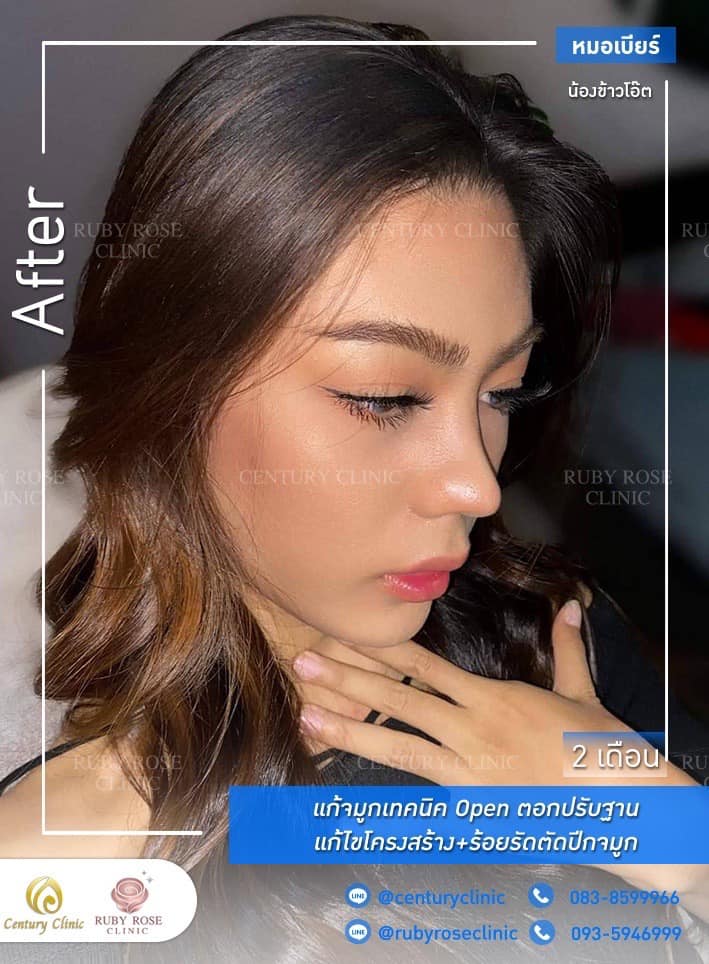รีวิว แก้จมูก #226 , Century Clinic Thailand Century รีวิว แก้จมูก #226