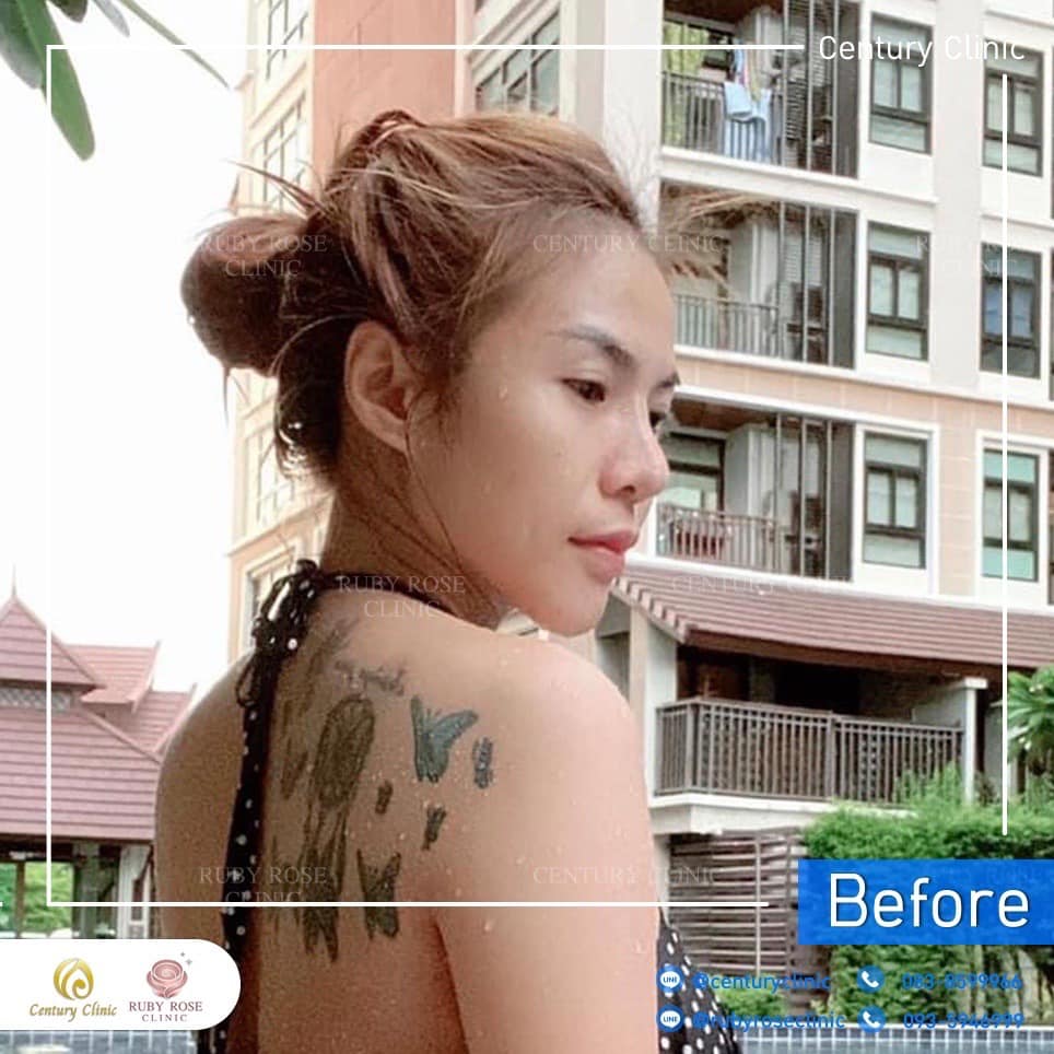 Century รีวิว แก้จมูก 2#268