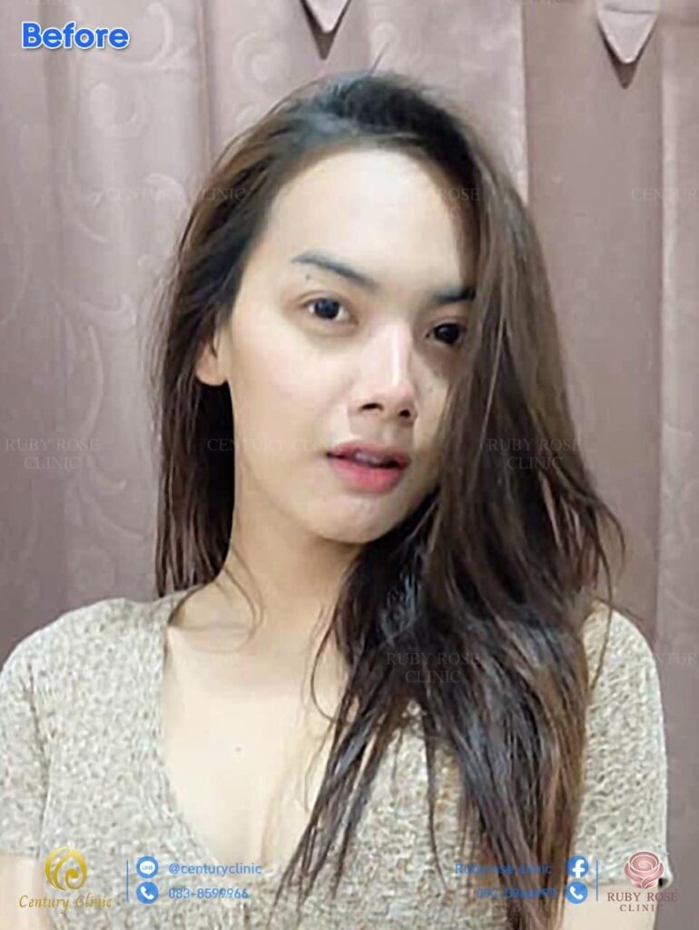 Century รีวิว แก้จมูก 2#272