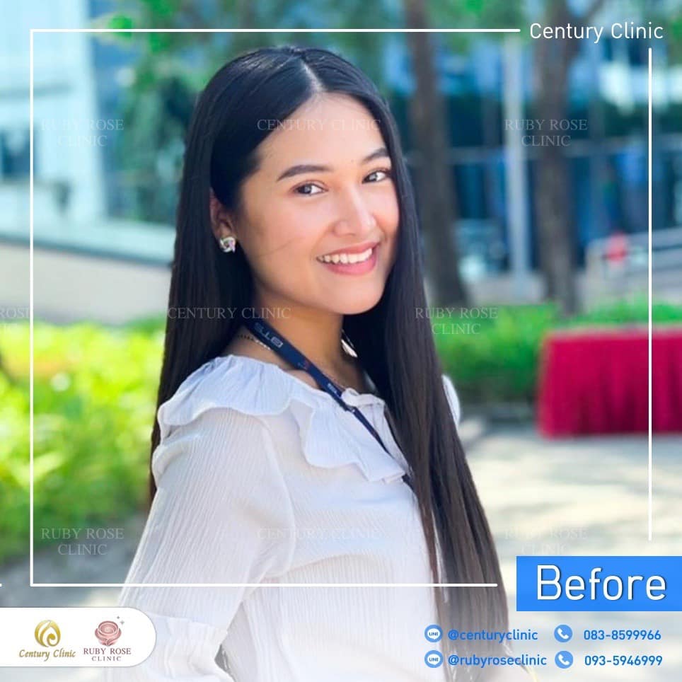 รีวิว แก้จมูก #275 , Century Clinic Thailand Century รีวิว แก้จมูก 2#275