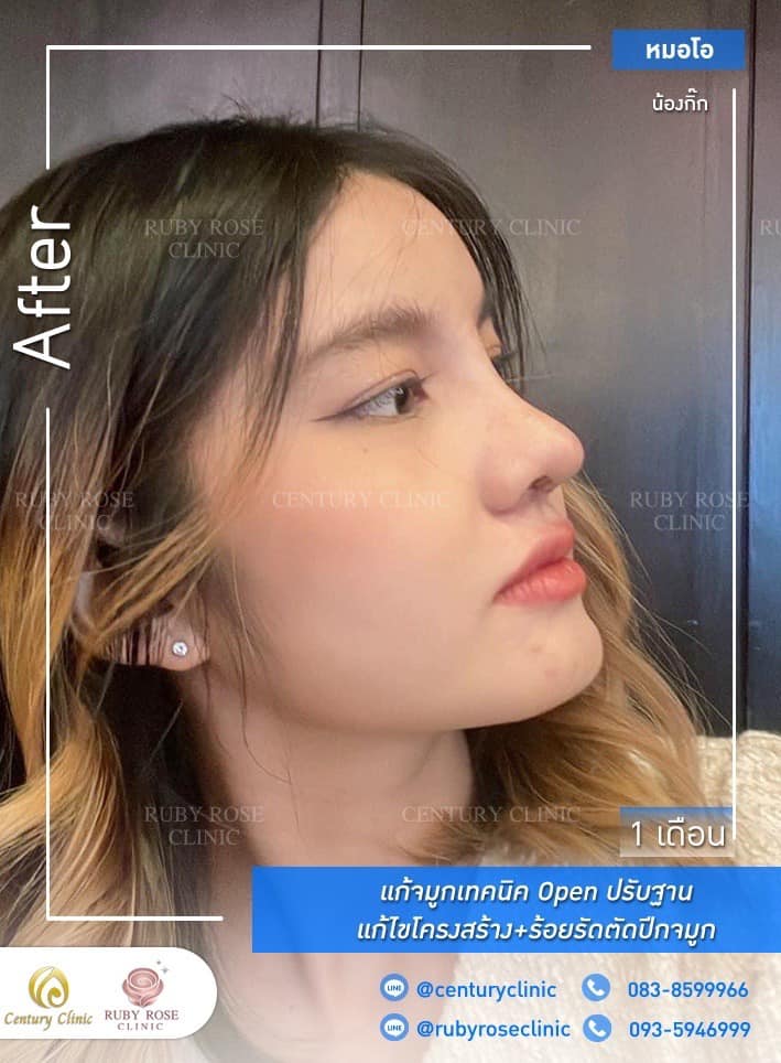 รีวิว แก้จมูก #230 , Century Clinic Thailand Century รีวิว แก้จมูก #230