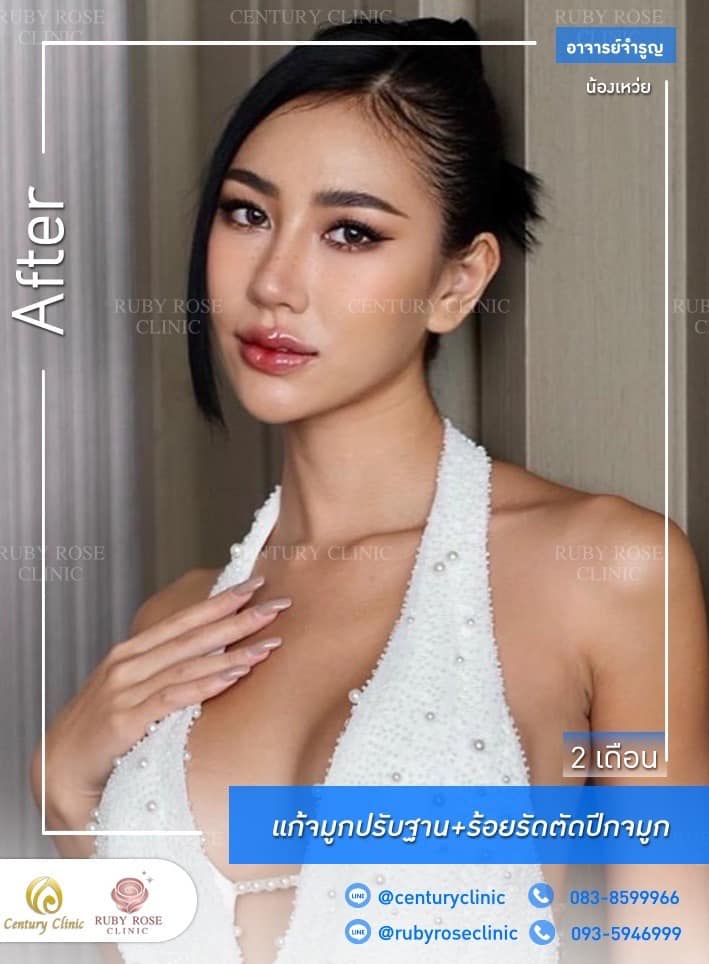 Century รีวิว แก้จมูก #239