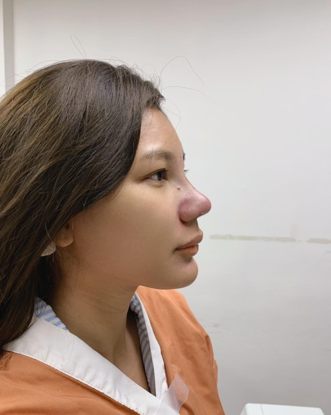 รีวิว แก้จมูก #242 , Century Clinic Thailand Century รีวิว แก้จมูก #241