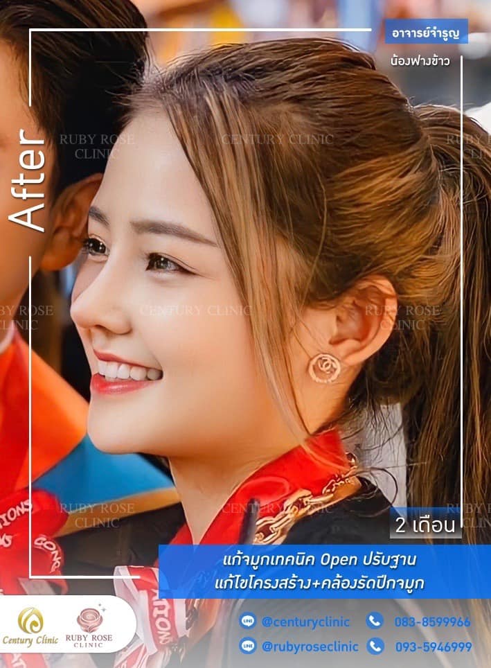 Century รีวิว แก้จมูก #247