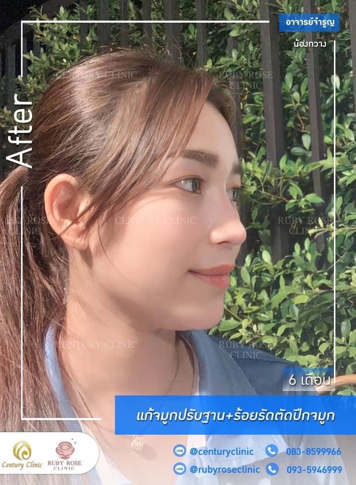Century รีวิว แก้จมูก #248